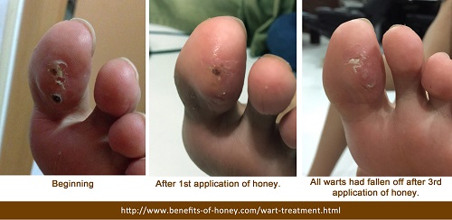 wart treatment with honey image